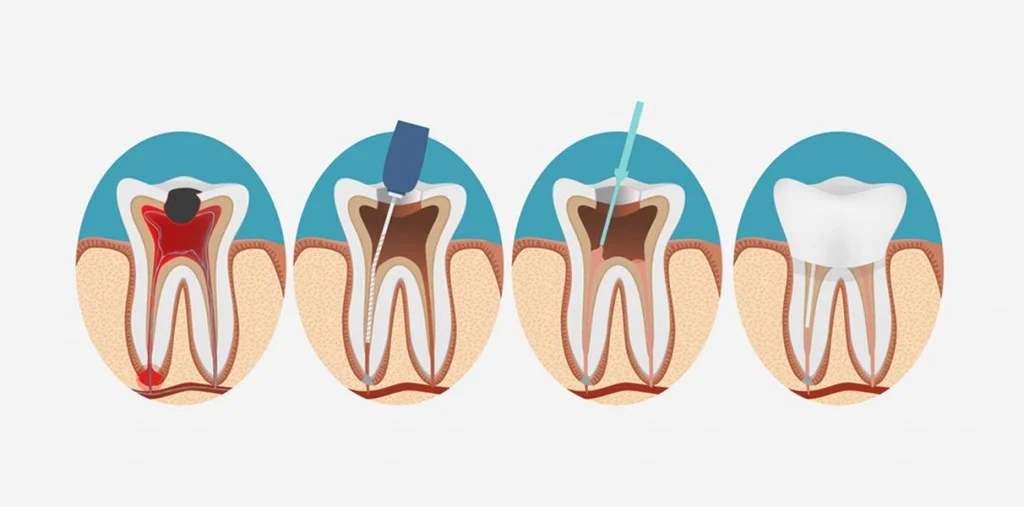 Endodontie Wurzelkanalbehandlung — Zahnarztpraxis Dr. Hauschildt Berlin-Reinickendorf